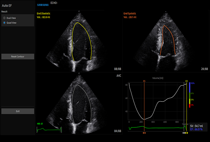 자동 EF(박출률) 계산