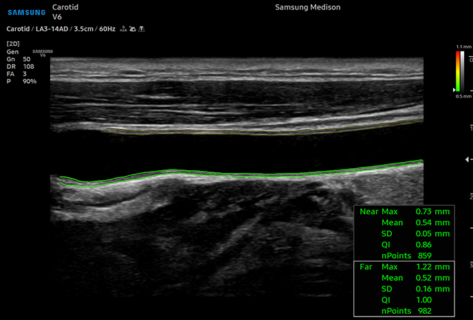 자동 IMT(경동맥 내막두께) 측정