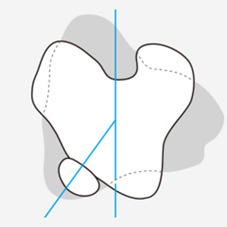 슬개골 탈구 단계 이미지 3
