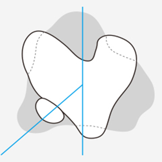 슬개골 탈구 단계 이미지 4