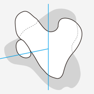 슬개골 탈구 단계 이미지 5