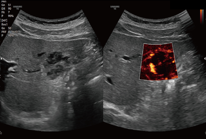 심장 초음파 예시 이미지 04