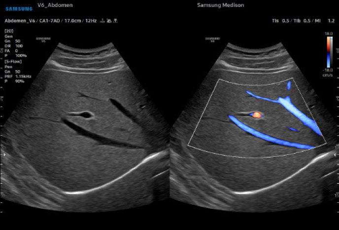 심장 초음파 예시 이미지 06